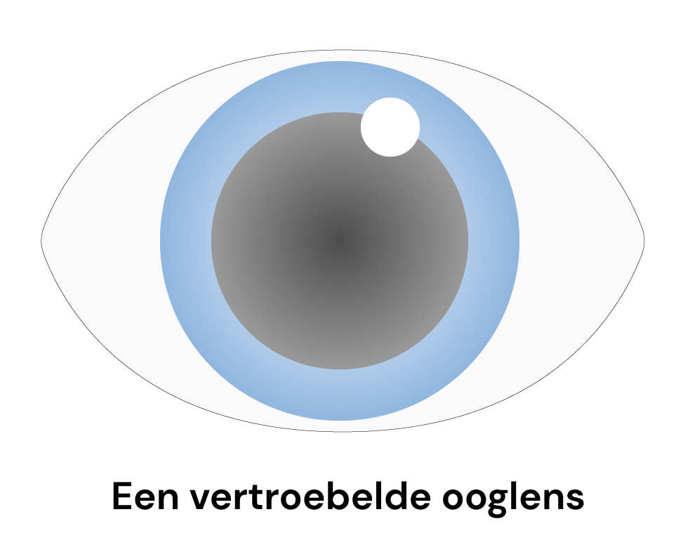 Een tekening van een vertroebelde ooglens