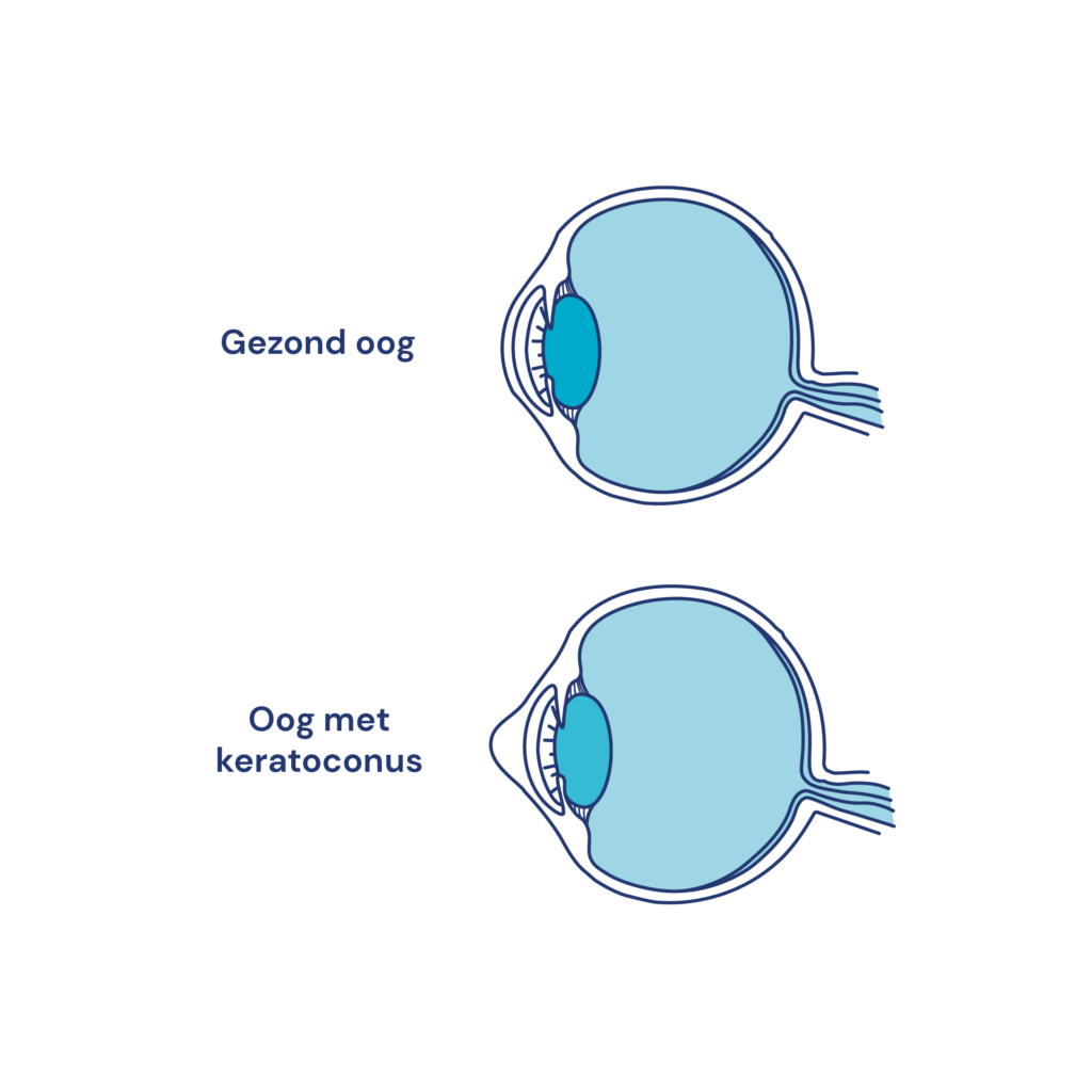 Een tekening waarop een gezond oog vergeleken wordt met een oog met keratoconus.