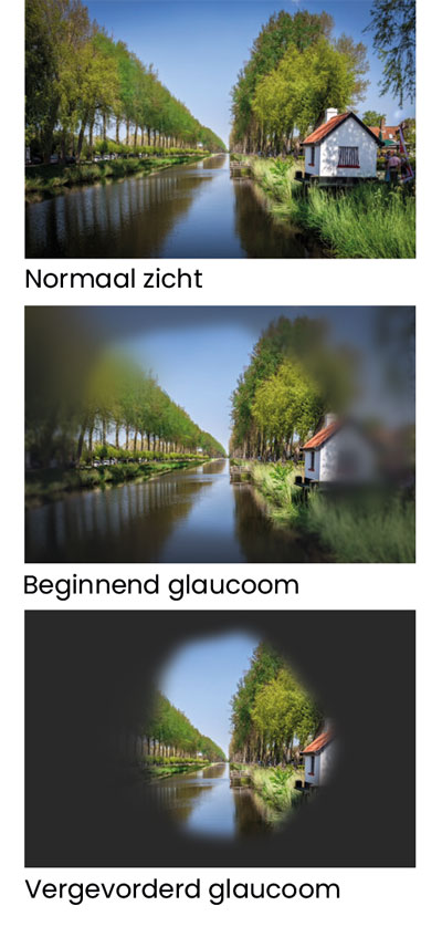 De vergelijking tussen normaal zicht, zicht bij beginnend en bij vergevorderd glaucoom.